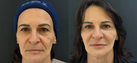 Antes e depois de uma paciente de frente: rosto mais descansado e firme