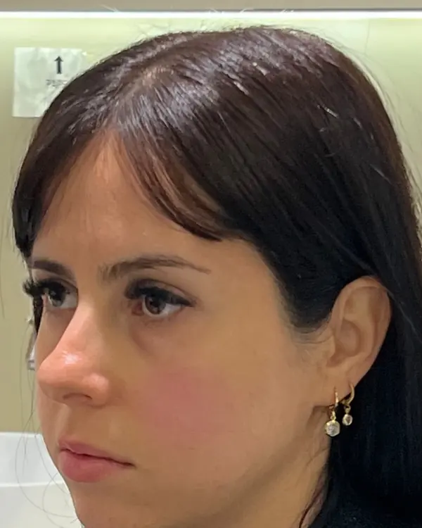 Antes: traços com pouca definição