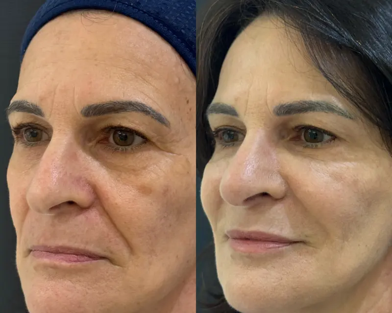 Antes e depois de perfil de uma paciente: rosto mais firme e descansado