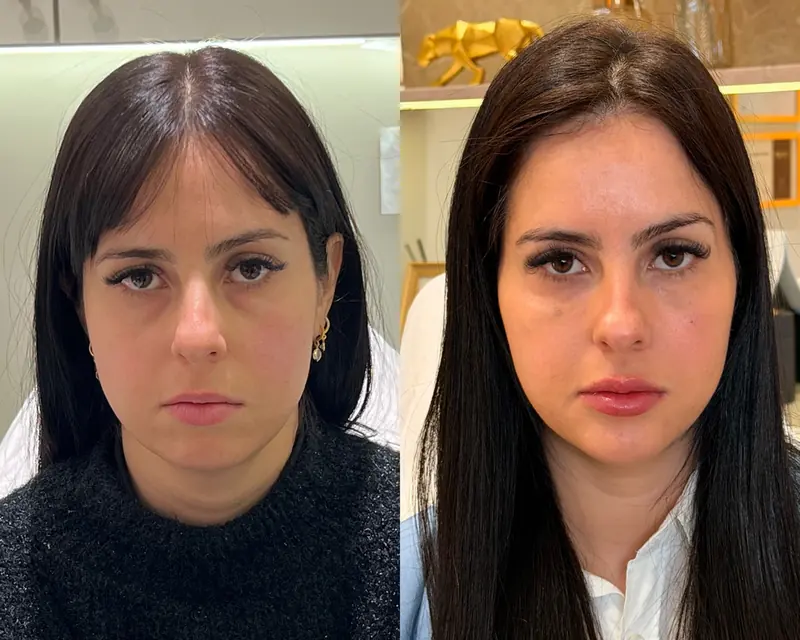 Antes e depois de frente de uma paciente jovem: traços mais equilibrados