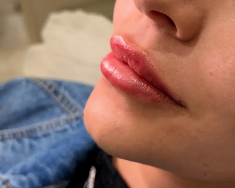 Lábios com contorno definido e volume natural depois do preenchimento