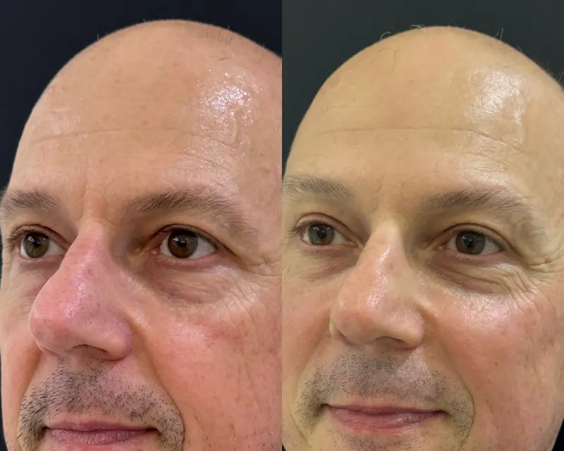Antes e depois de um paciente homem: rosto mais descansado