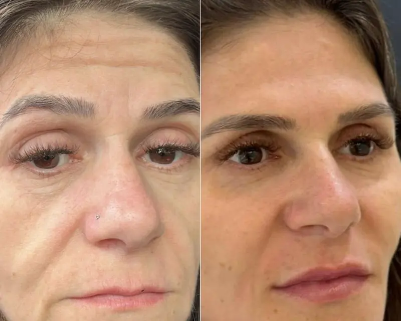 Antes e depois de uma paciente ao longo de um ano: pele mais firme e uniforme
